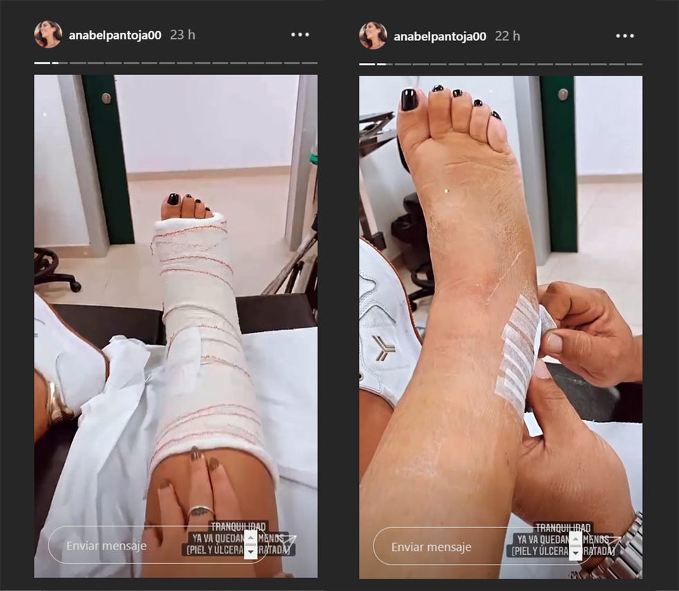 pie de anabel pantoja escayolado
