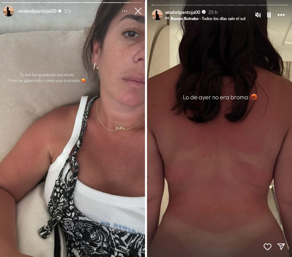 anabel pantoja sufre quemaduras por el sol tras quedarse dormida en la piscina