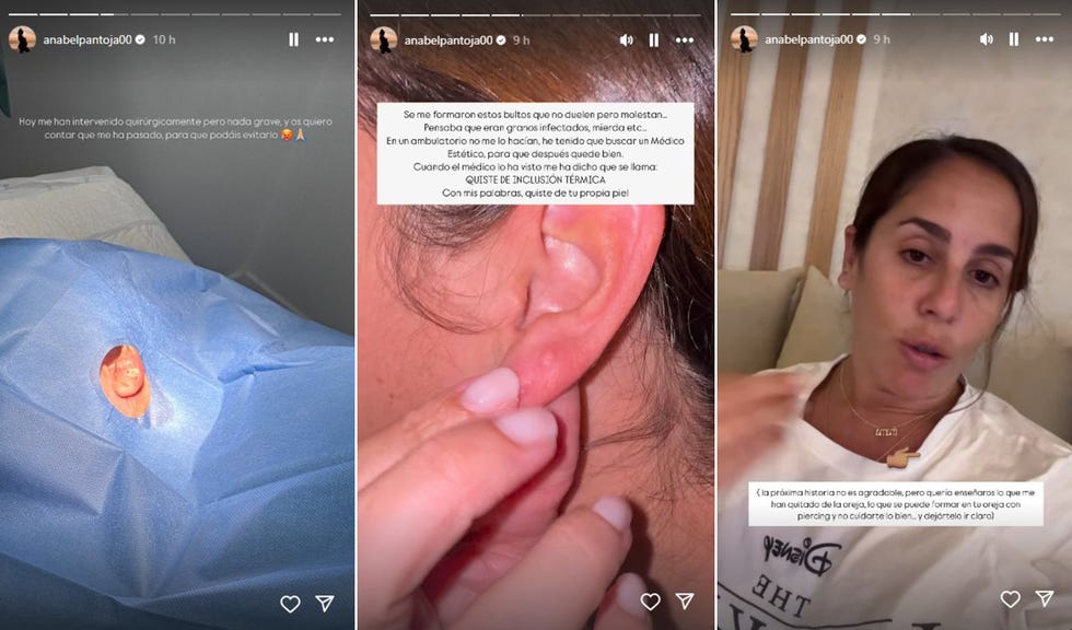 anabel pantoja muestra los quistes en la oreja por los que ha tenido que ser operada
