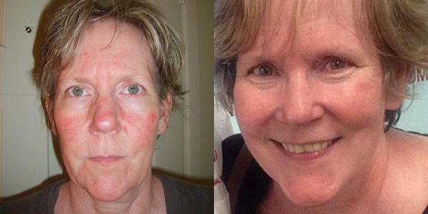 ann before/after rosacea