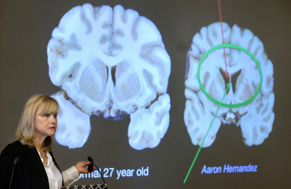 Ann McKee compares brains of normal 27-year-old and Aaron Hernandez
