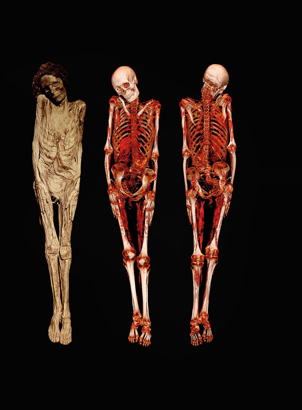 De Guanchemummie was in 1878 te bewonderen op de Wereldtentoonstelling in Parijs Decennialang was de linkerfoto de beste afbeelding die van de mummie was gemaakt Het gebalsemde lichaam was lange tijd te zien in het Nationaal Museum voor Antropologie maar werd in 2015 verplaatst naar het Nationaal Archeologisch Museum in Madrid waar het uitgebreid werd onderzochtHet haar dat aan de schedel is bevestigd stamt uit dezelfde periode als het lichaam de twaalfde of dertiende eeuw maar het is niet met zekerheid te zeggen of het bij het lichaam hoort De CTscan toont aan dat Canarische xaxos niet van hun ingewanden werden ontdaan in tegenstelling hun Egyptische tegenhangers De lever nieren longen en het hart zijn zichtbaar links De zeer goed geconserveerde huid spieren en botten zijn gedroogd met behulp van kruiden schors en lapilli vulkanische steentjes om ontbinding tegen te gaan