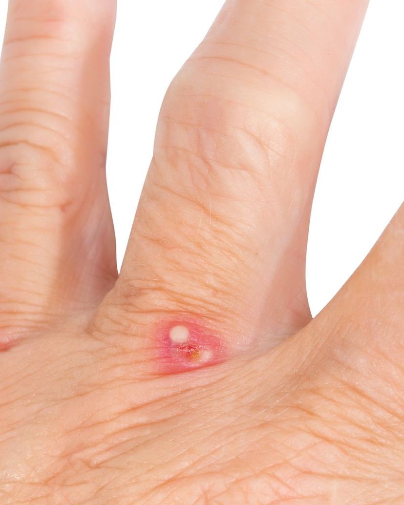 Bites and Stings: Pictures, Causes, Symptoms, and Treatment
