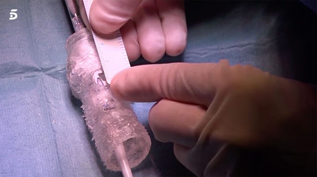 Imprimen una prótesis de aorta 3D y salvan la vida a un hombre