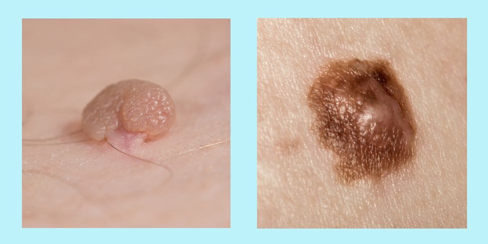 images of cancerous skin tags