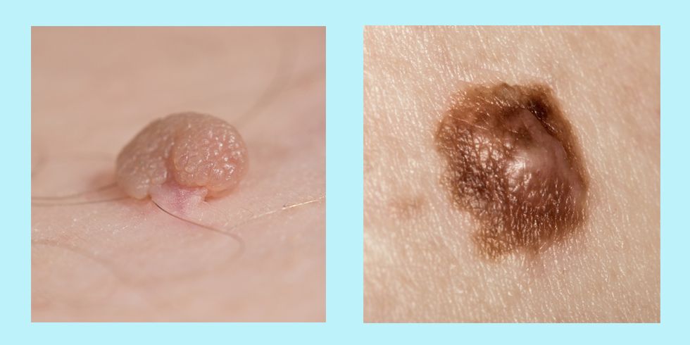 are skin tags cancerous