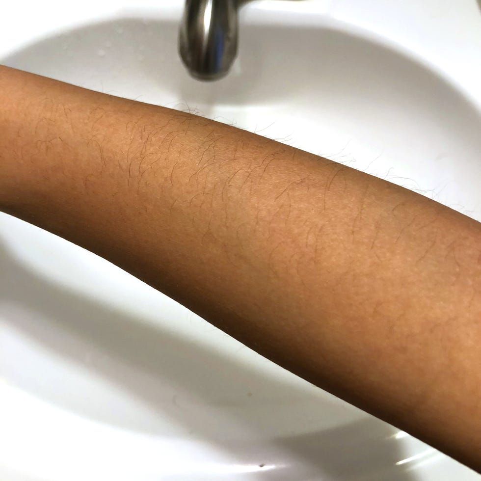 My arm before using Billie.