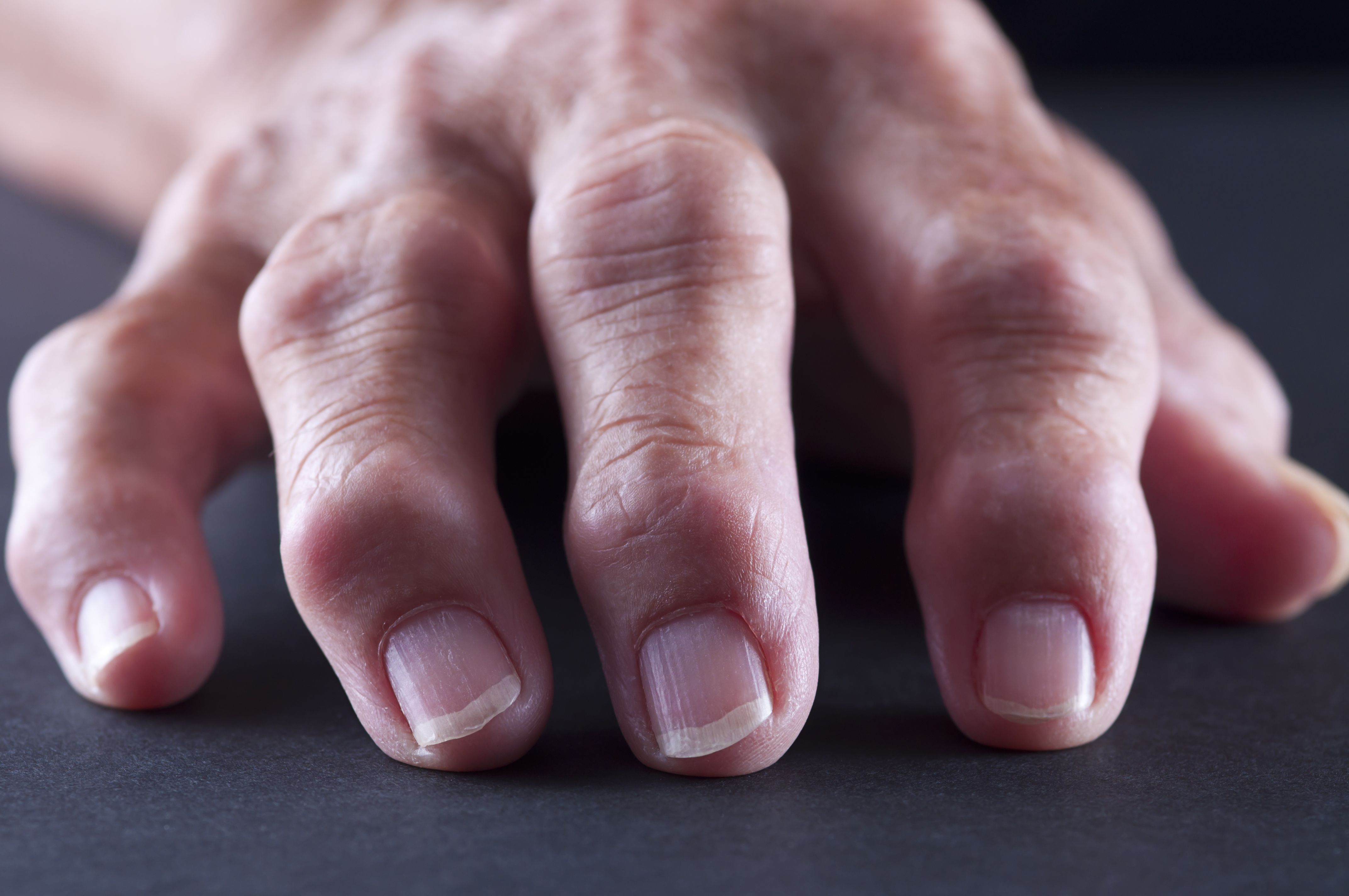 Arthritis in the Fingers and Knuckles: Pictures and Symptoms