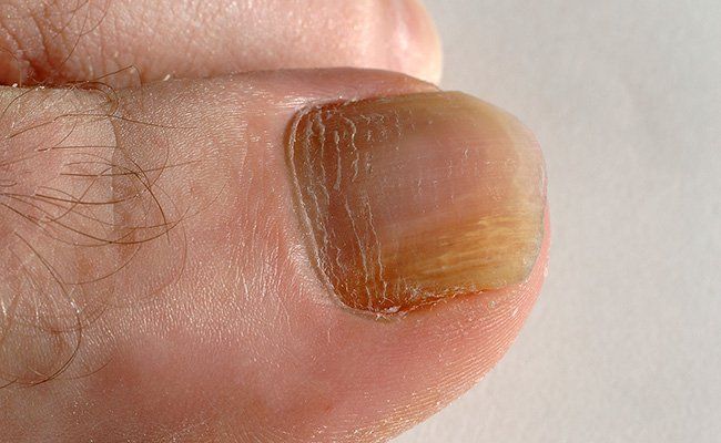 Fungal nails: Why do my toenails look like they are dying? - The Foot Group