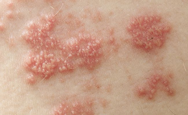Shingles Increases Your Health Risk