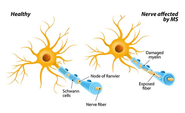 7 Things You Don't Know About Multiple Sclerosis 