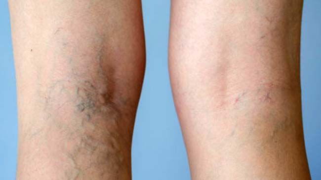 Natural Remedies For Varicose Veins