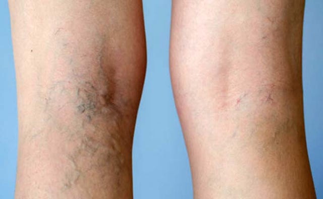 Natural Remedies For Varicose Veins