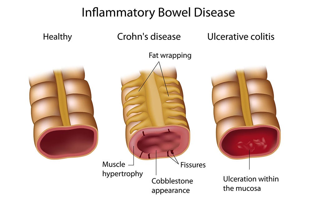 Crohn's Disease and Ulcerative Colitis: Calm the Flame in Your Gut