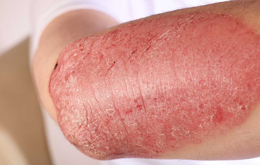 Living With Psoriasis