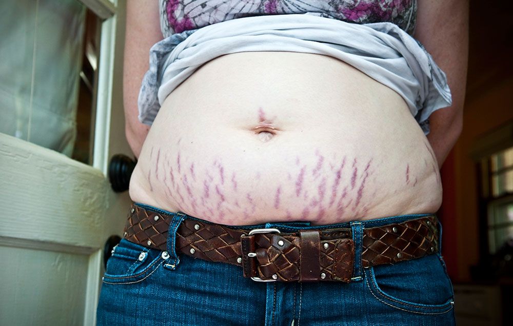 7 Things You Need to Know Treating Stretch Marks Prevention