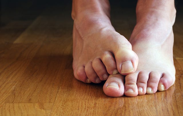 How to Fix Your Grossest Feet Problems