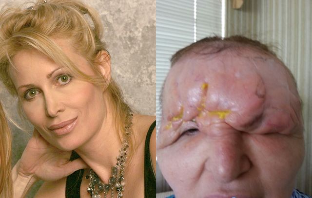 carol bryan before and after getting fillers