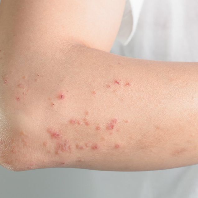 7 Reasons Why You Might Be Breaking Out in Hives