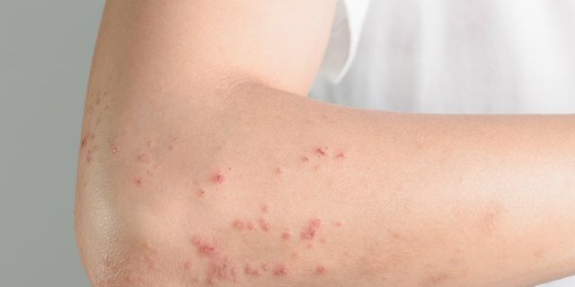 Why do I get rash near my bra area? – Cottonique - Allergy-free Apparel
