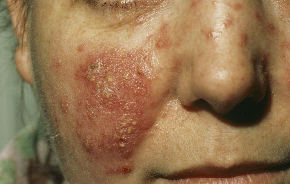 Could You Have Rosacea—or Your Skin Just Red? | Health