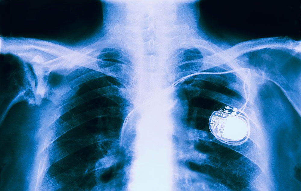 This Is What It Feels Like To Have A Pacemaker Prevention   Shutterstock 344282462 Speedkingz Opener 1486061985 