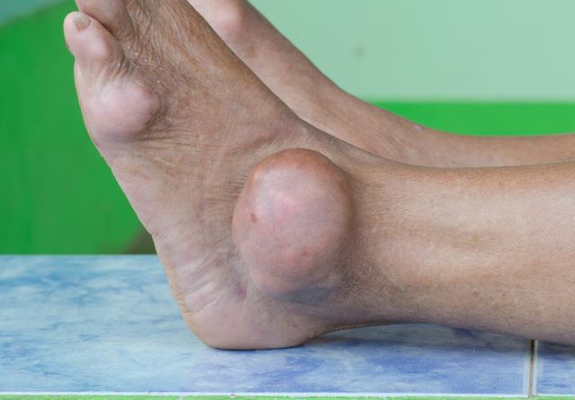 Signs of gout