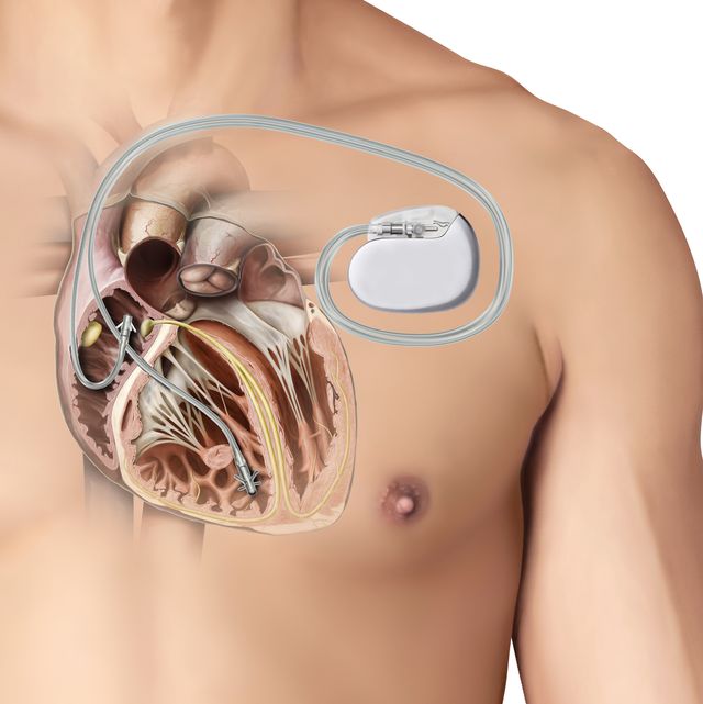 Artificial pacemaker