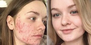 Are You Dealing With Cystic Acne? - Women's Health UK