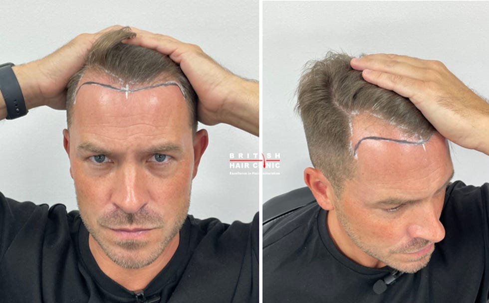 ashley taylor dawson at the british hair clinic