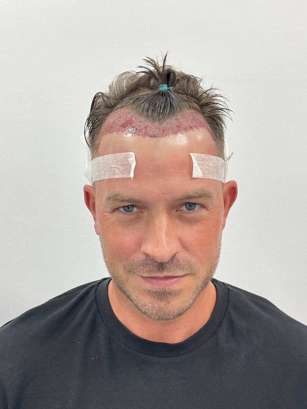 ashley taylor dawson at the british hair clinic