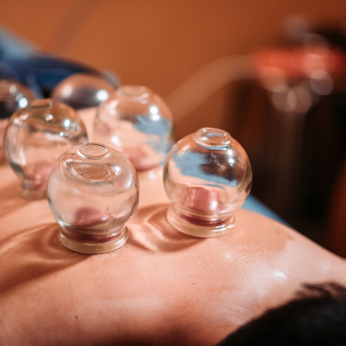 asian chinese male patient receiving cupping therapy treatment at chinese medicine shop