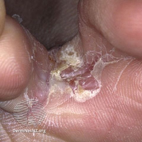 athlete's foot skin rash