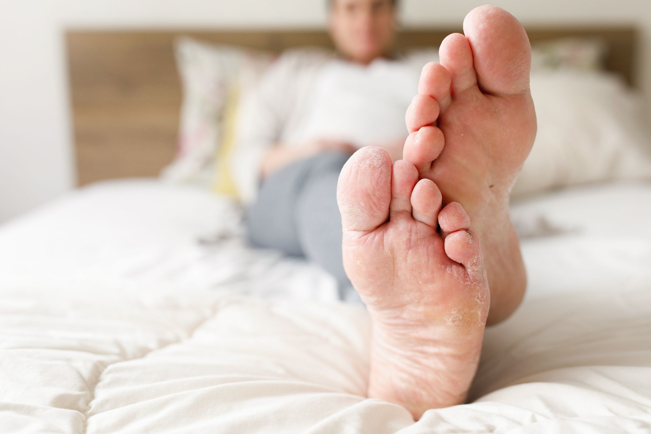 Why Are Your Feet Peeling? 4 Reasons Why and How to Stop It