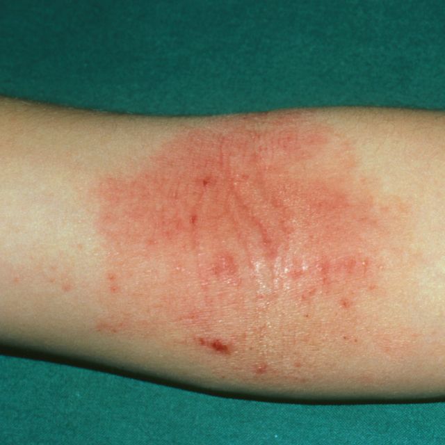 Eczema Causes, Symptoms, & Treatments - How to Get Rid of Eczema