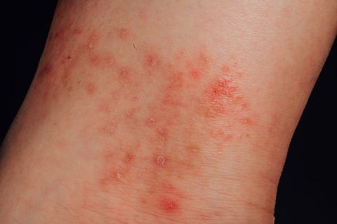 atopic eczema allergy texture of ill human skin