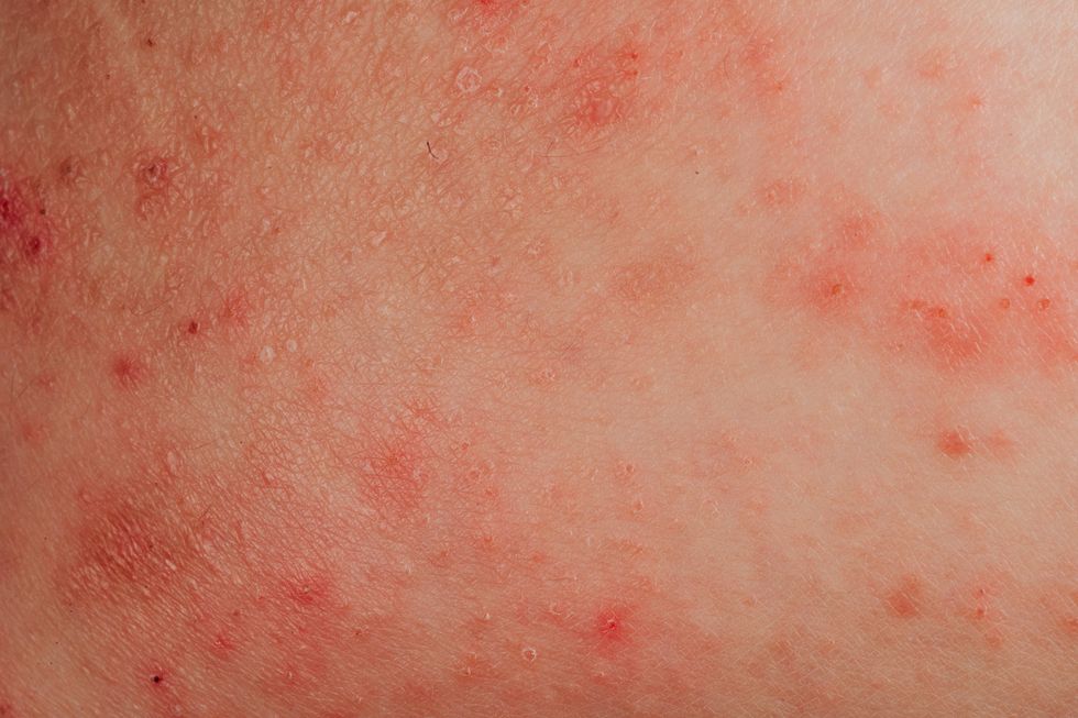 atopic eczema allergy texture of ill human skin