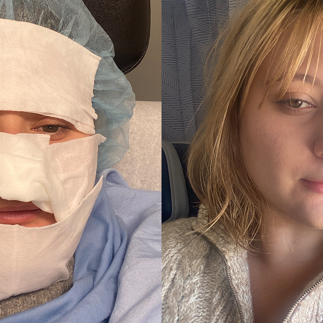 I've Had Acne for 12 Years, and This Buzzy Treatment Finally Cleared My Skin