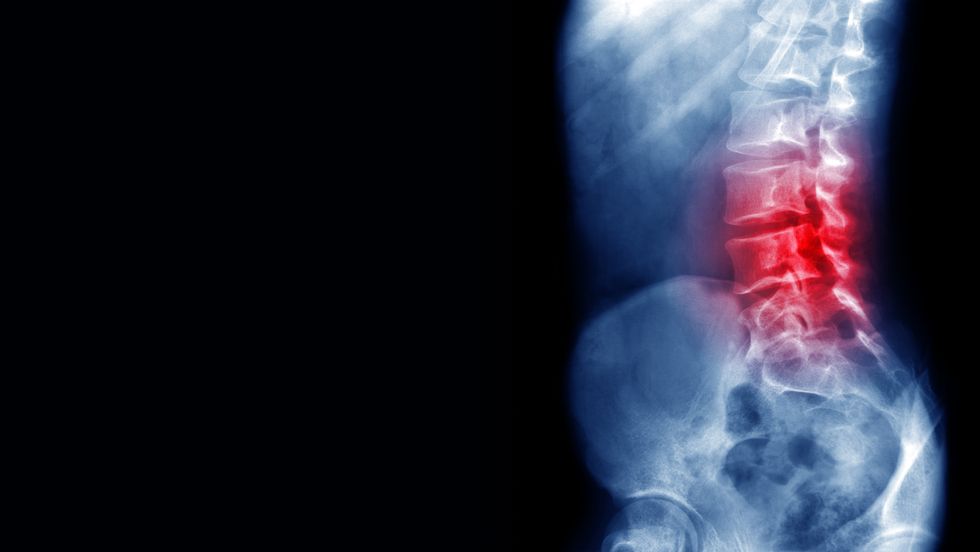 back pain x ray