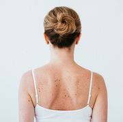 back view of woman with melanoma on diseased skin isolated on white