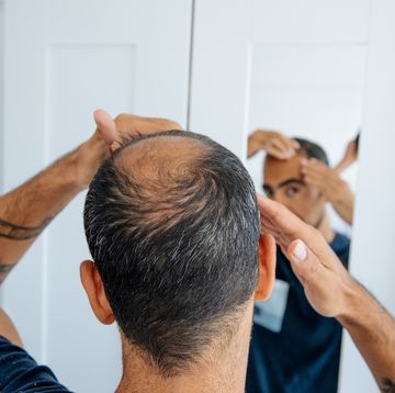 bald man looking mirror at head baldness and hair loss