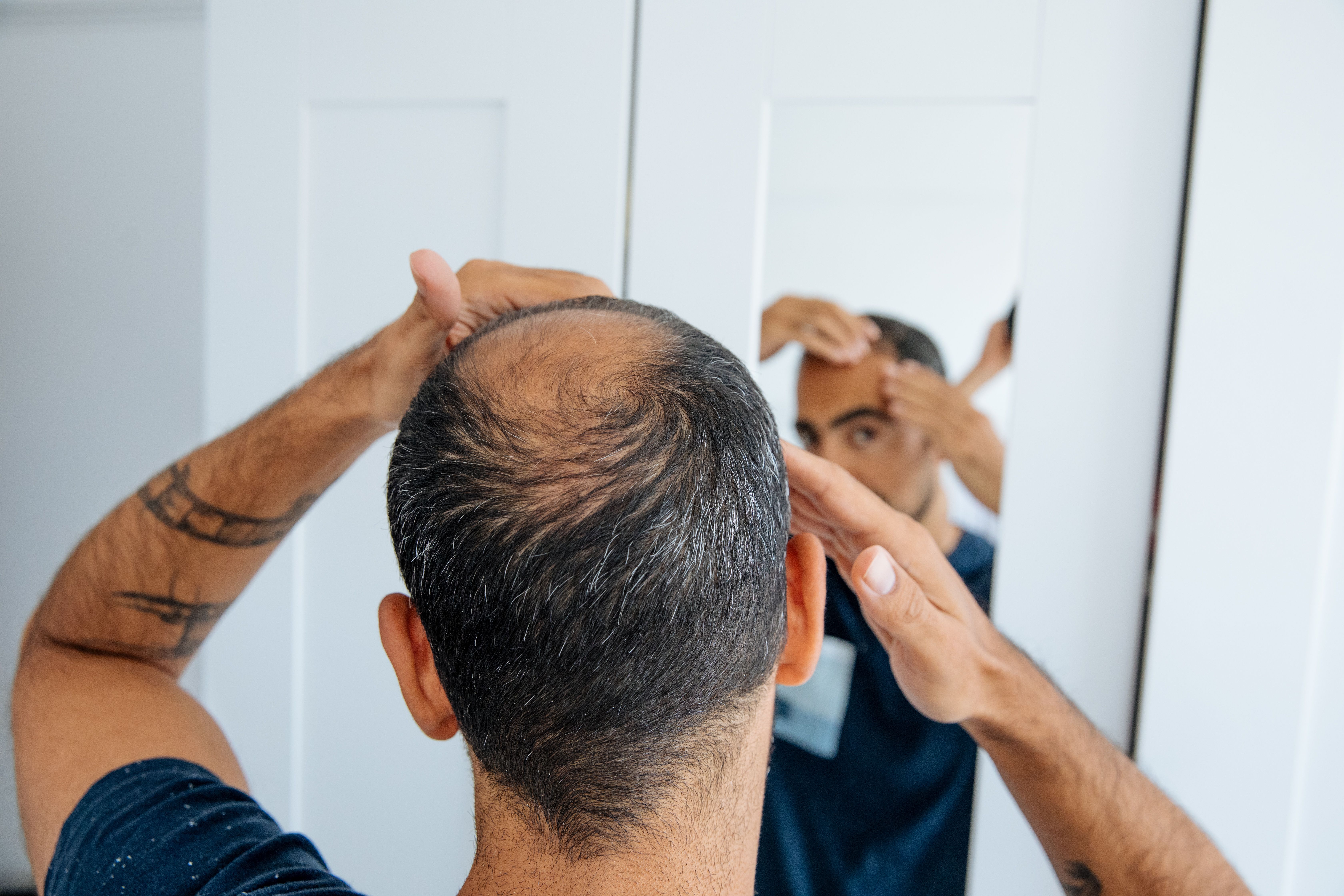 Một người đàn ông hói đầu đang soi gương