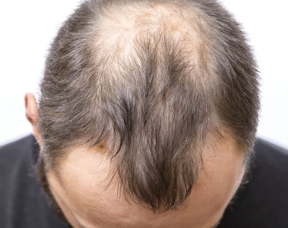 balding young man, hair loss problem
