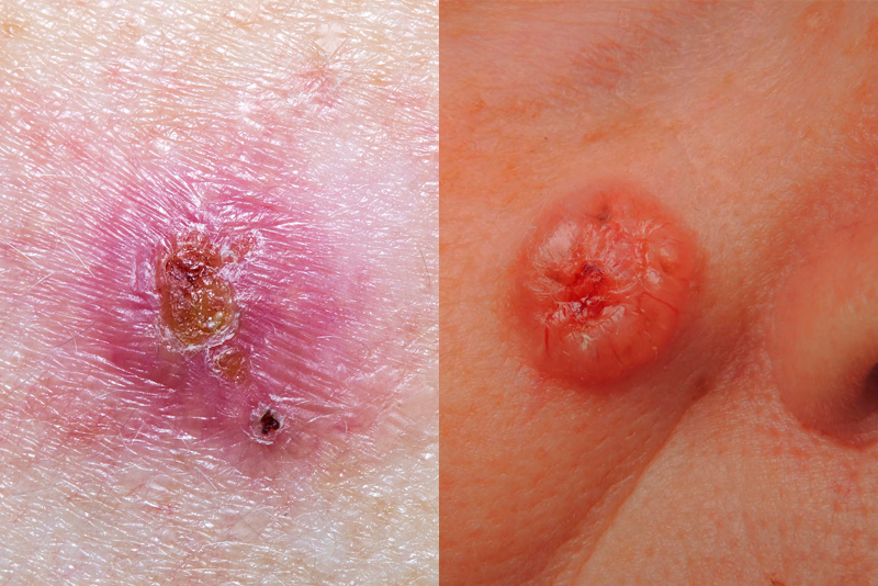 How to Spot Skin Cancer: What Does Skin Cancer Look Like and Is It Itchy?