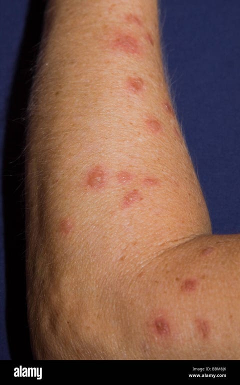 Red Bumps On Arms Not Itchy