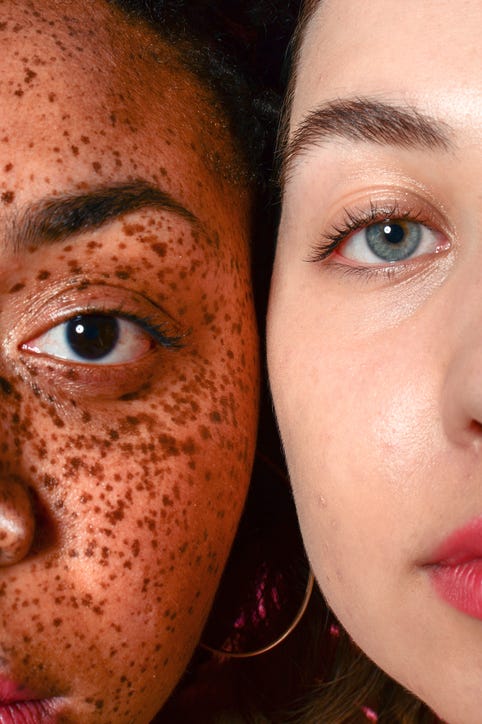 beauty portrait of young women with freckles and acne