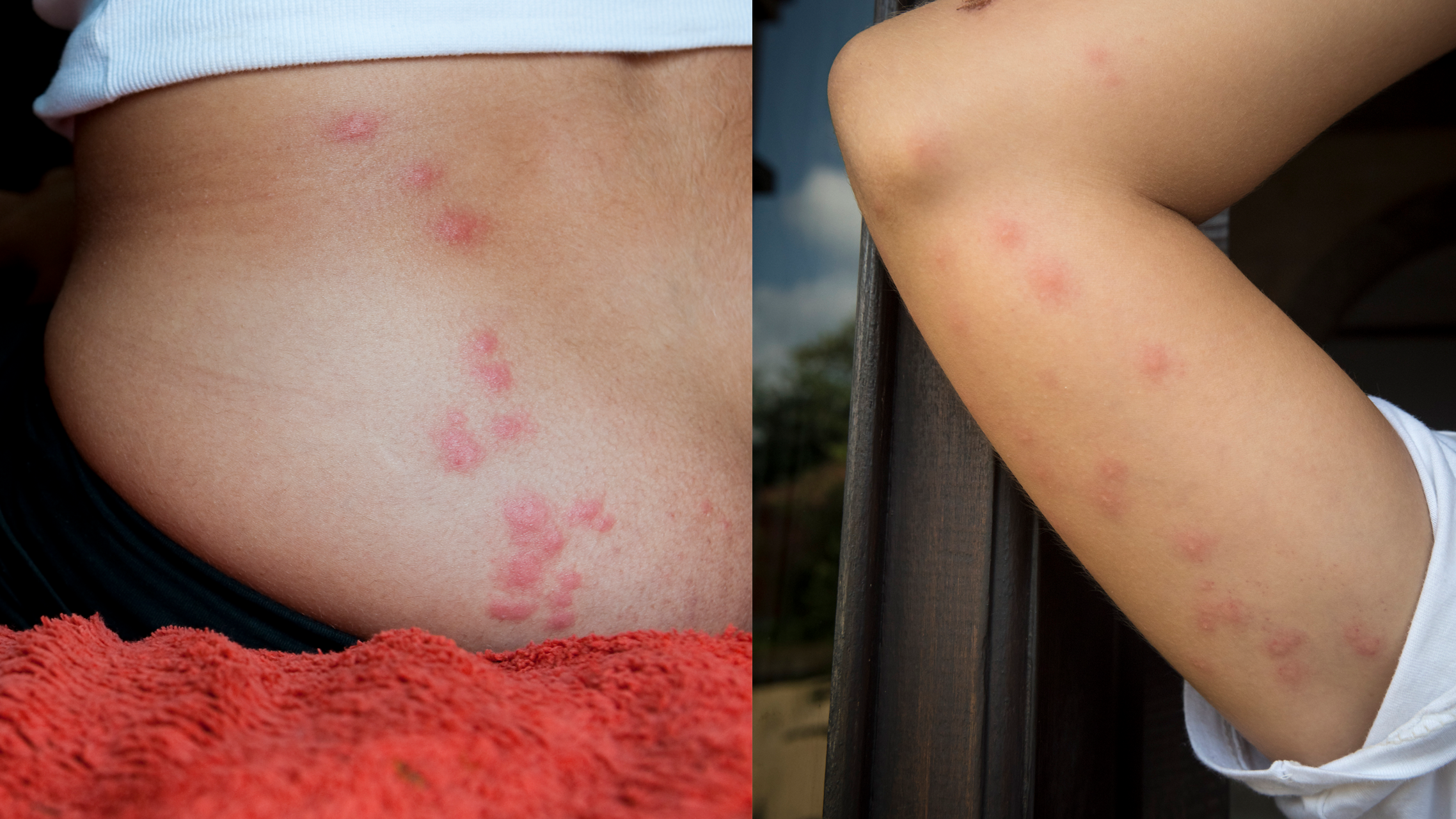 Bed Bug Bites Pictures, Symptoms: What Do Bed Bug Bites Look Like?