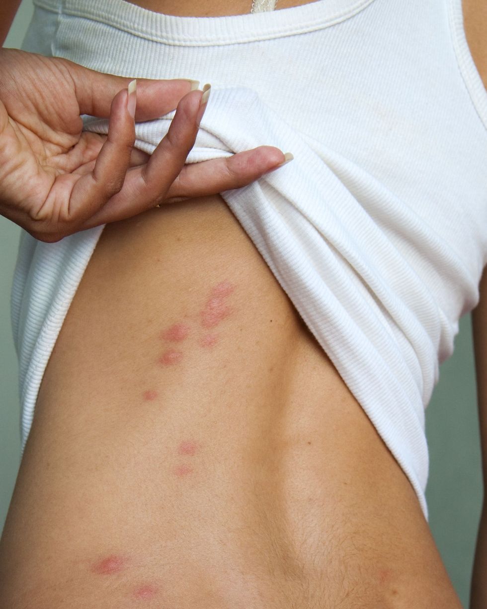 Mosquito Bites on the Skin Under the Breast Stock Photo - Image of body,  blood: 198748858
