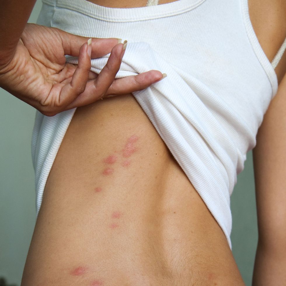 what do bed bug bites look like