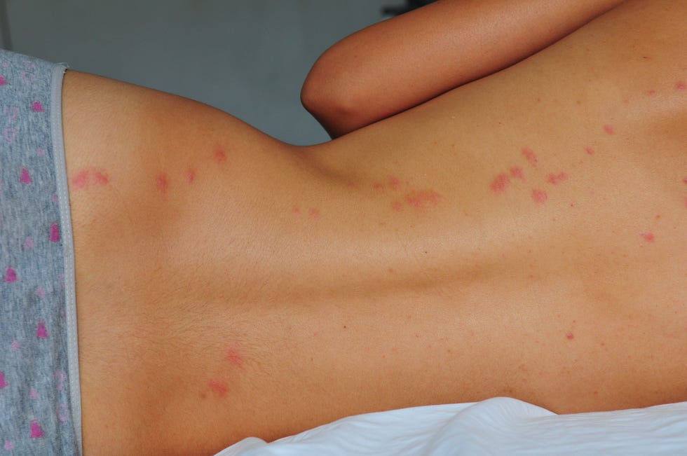 Identifying Insect Bites: Pictures Of 11 Common Bug Bites